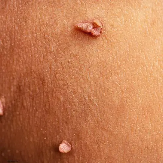 causes skin tag